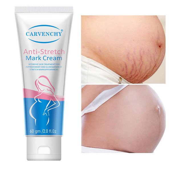Anti Stretch Mark Cream repairs and dilutes fine lines and postpartum fat lines repair cream